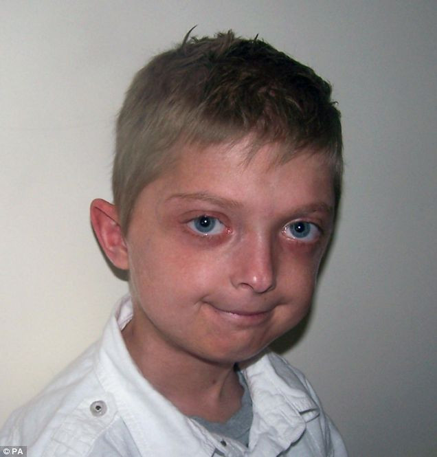 DRAMATIC: imbatranire prematura! Are 11 ani, dar arata de 40!