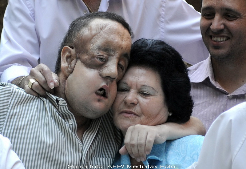 Inainte si dupa! Uite cum arata dupa un transplant partial de fata!