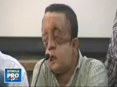 Transplant de fata partial, in Spania