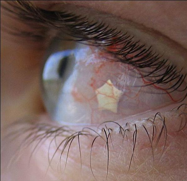 Ce isi mai fac oamenii cand se plictisesc? Piercing in ochi! Operatia,VIDEO