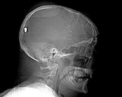 Traieste cu un glont in creier! I-a intrat prin ochi, dar nu stie cum