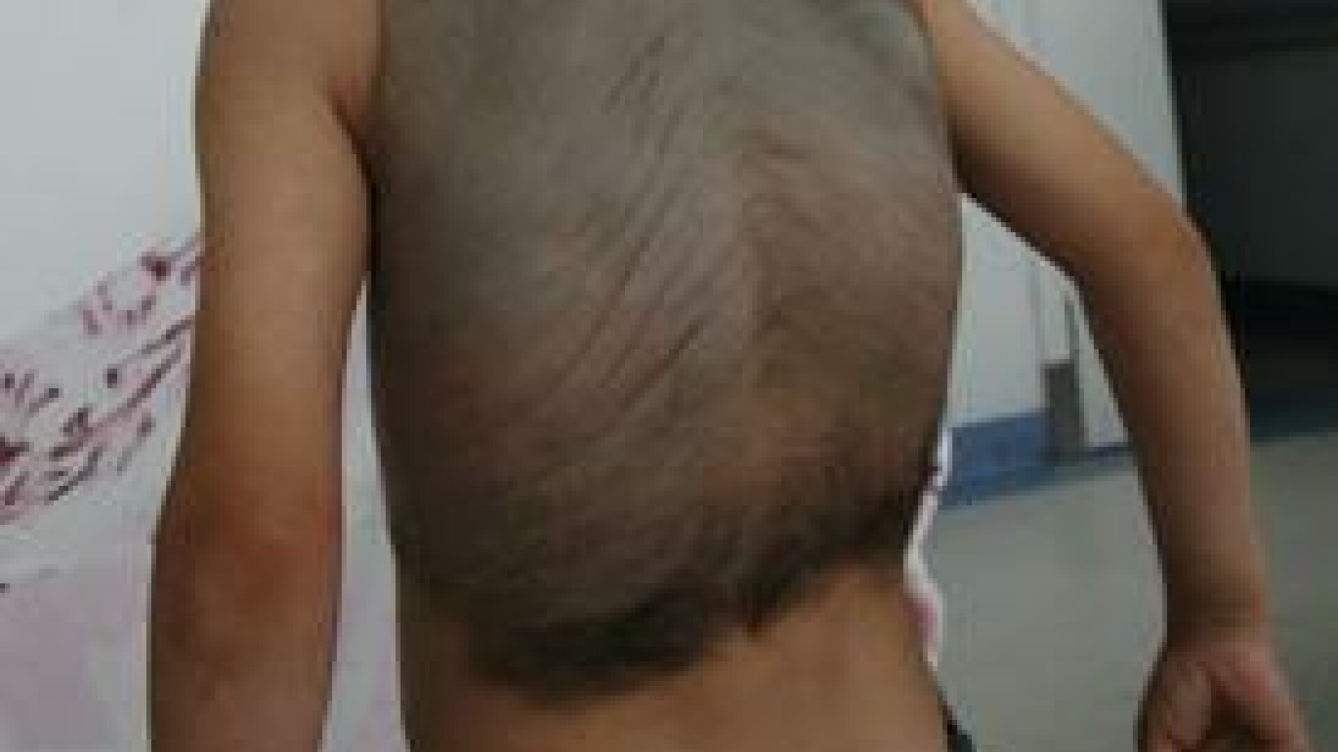 Baiatul-broasca testoasa! I-a crescut o carapace pe spate