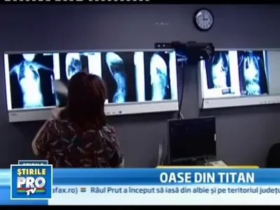 Copii cu malformatii grave, salvati de coastele din titan