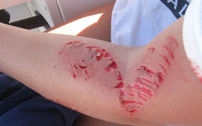 Socant! O stiuca de mare i-a sfartecat bratul