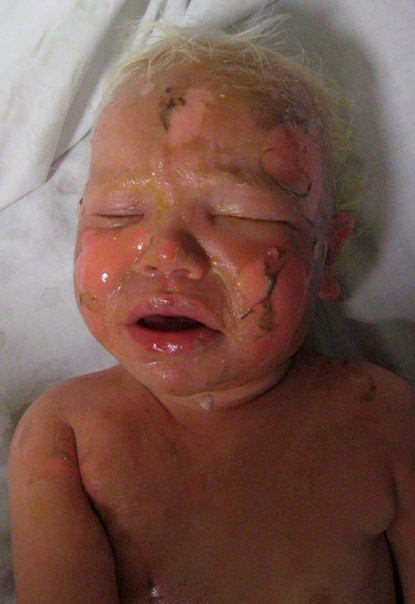 Miracolul vietii! A avut fata complet arsa, dar s-a refacut uimitor