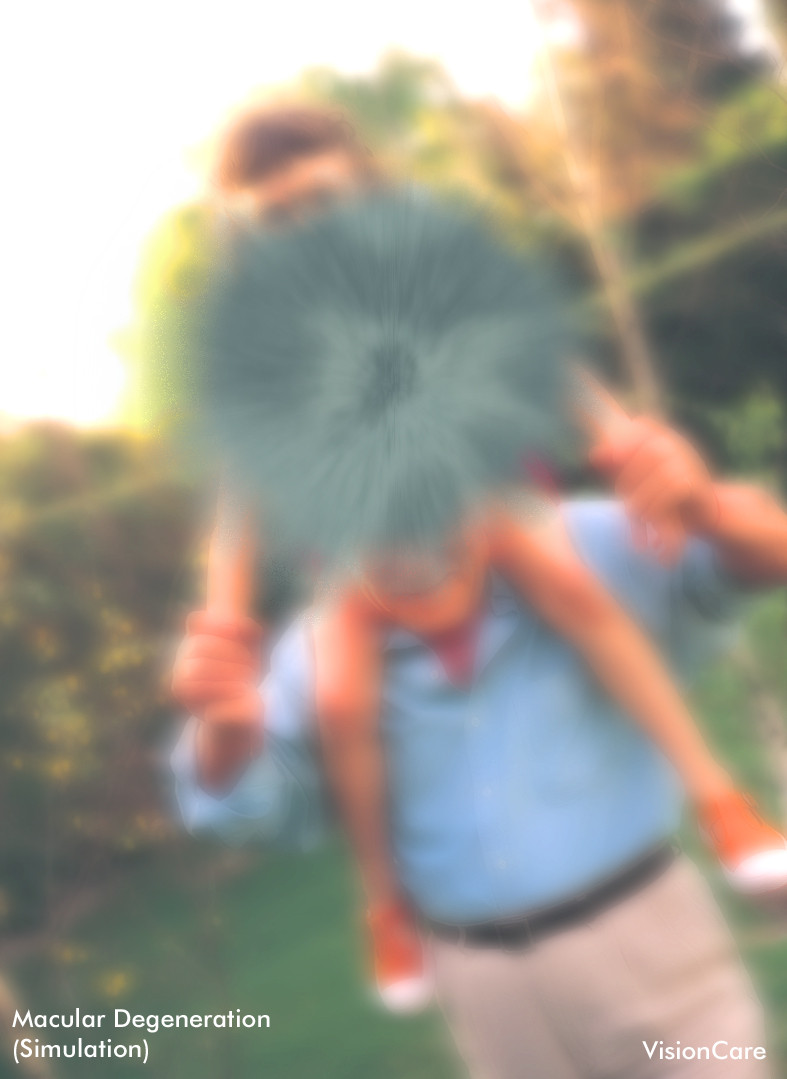 Degenerescenta maculara