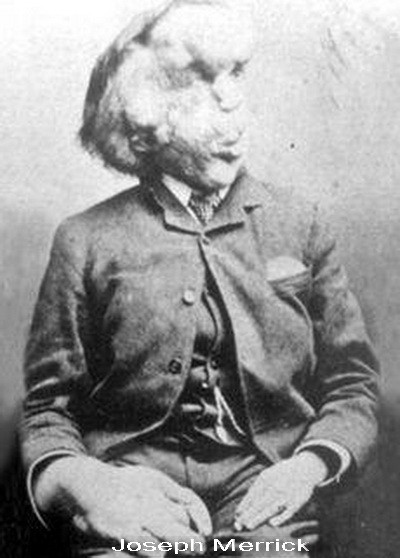 Joseph Merrick