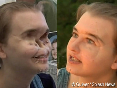 Fata cu jumatate de fata a primit un nou chip