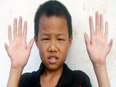 Soc la nastere! 12 degete la maini si 12 la picioare sau penis pe spate