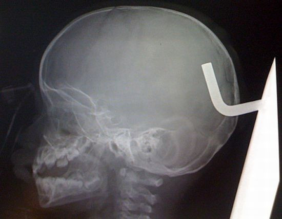 Radiografii terifiante: foarfece in cap, cuie in gat si furculite in mana
