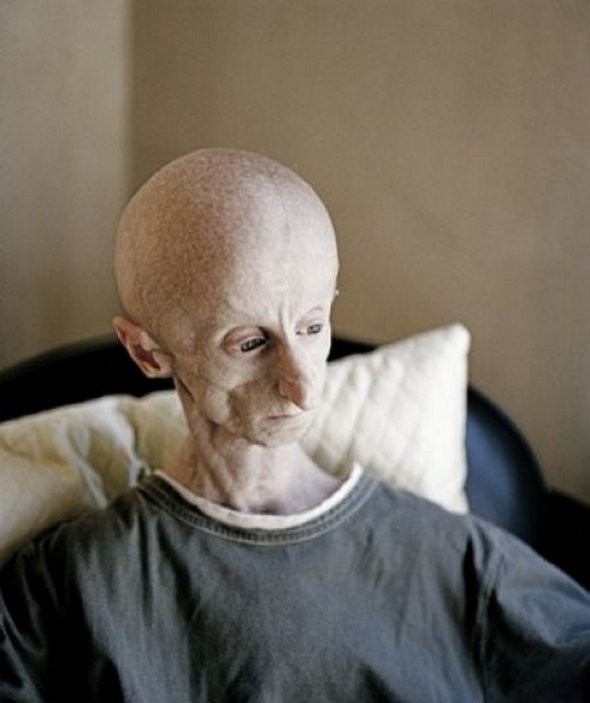 Uluitor! Omul cu chip de extraterestru! Traieste printre noi