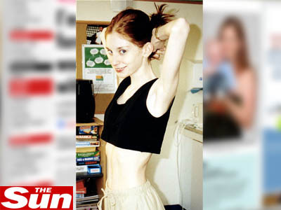 Povestea unei anorexice:M-au fortat sa mananc, altfel muream in cateva zile