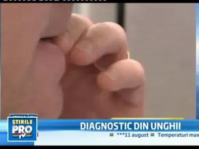 Unghiile, barometrul corpului uman! Asta spun cercetatorii americani
