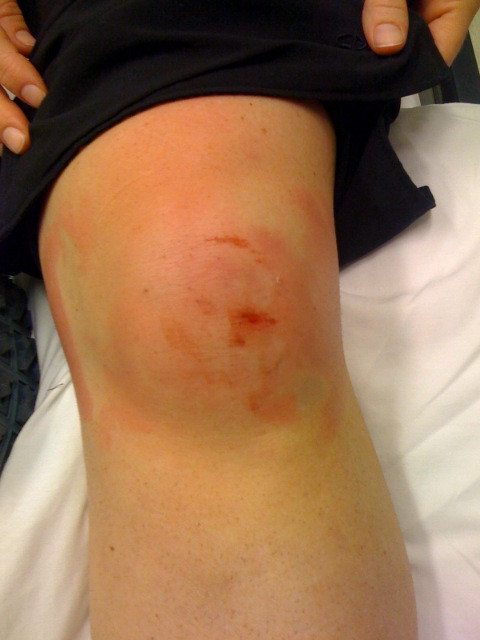 S-a lovit la genunchi, insa a crezut ca nu e ceva grav. Ce a descoperit trei saptamani mai tarziu