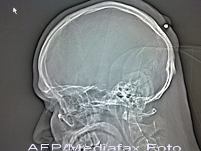 A descoperit ca are un glont in cap dupa 5 ani de cand a fost impuscat
