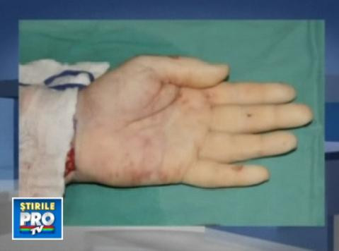 Operatie miraculoasa: dublu transplant de mana