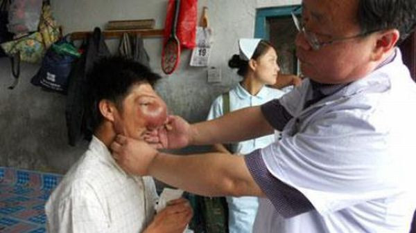 Traieste in infern! Un chinez desfigurat de cancer i-a socat pe medici