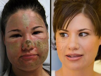 Atacuri in serie cu acid in America! Victimele sunt toate femei