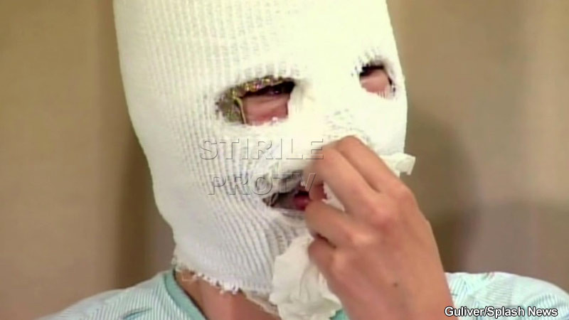 Mutilata pentru ca era prea frumoasa. O studenta a fost atacata cu acid de o prietena geloasa