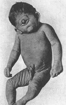 cyclopia