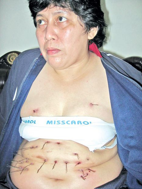 Incredibil! Ii cresc sarme in stomac si ii ies prin piele!