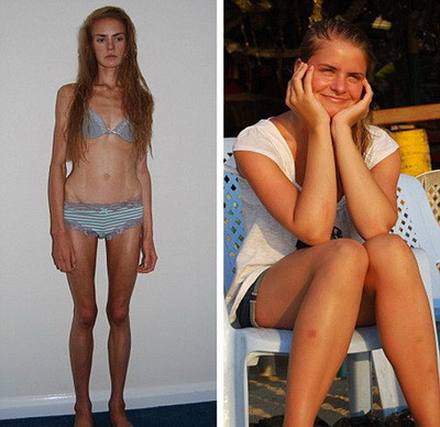 Ai grija ce dieta tii! O adolescenta de 16 ani a murit din cauza anorexiei!