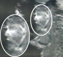 Bolnav de cancer spune ca l-a vazut pe Iisus in radiografie!