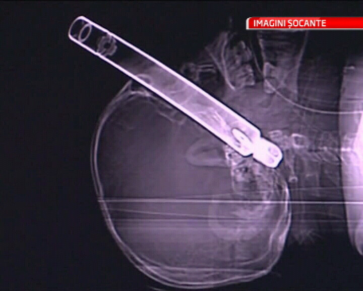 IMAGINI SOCANTE! A murit dupa ce o teava i s-a infipt in ochi