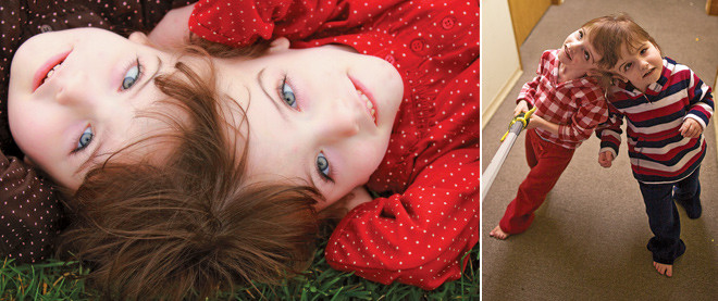 Fascinant! Povestea siamezelor care au acelasi creier, ganduri si simturi