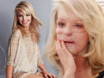 Dupa 5 ani de cosmar, Katie Piper, femeia mutilata de fostul iubit, este fericira: "O sa fiu mama"