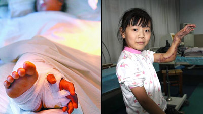 Incredibil! A stat 3 luni cu mana atasata de picior ca sa nu ramana fara ea