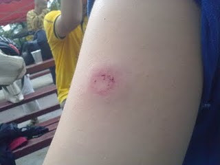 Nu neglijati vanataile care apar spontan in lipsa unui traumatism