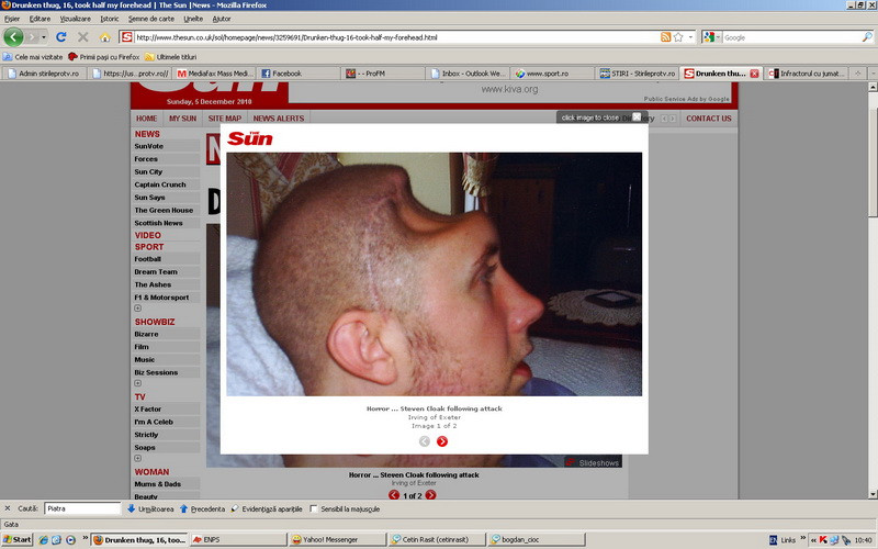 L-a desfigurat! Un adolescent beat l-a lasat pe un tanar fara frunte! FOTO