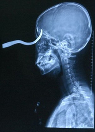 Radiografie socanta! A supravietuit dupa ce un carlig i-a strapuns ochiul!