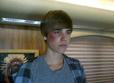 Justin Bieber cu ochiul invinetit! FOTO