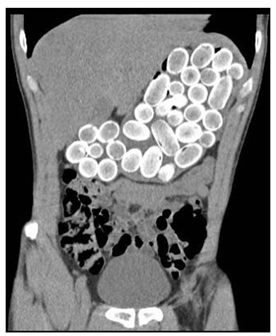 Insarcinata in 8 luni, a fost prinsa cu un kg de cocaina in vagin si stomac