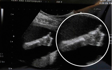 Ecografie impresionanta: "Totul e OK, mami!"