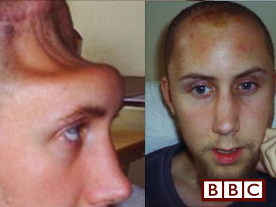 Si-a recapatat identitatea. I-au reconstruit jumatatea de craniu lipsa