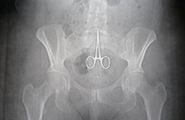 A suferit timp de 9 ani de dureri groaznice de stomac. Ce au descoperit medicii cand l-au operat