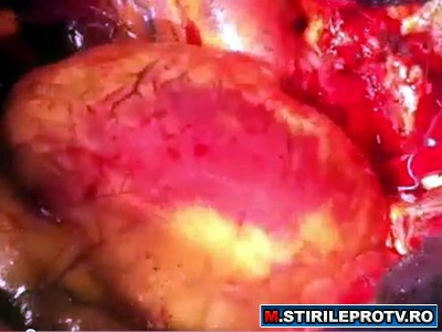 Asteapta un miracol. Povestea lui Dumitru, tanarul de 20 de ani care traieste cu inima in geanta