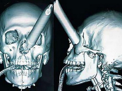 Omul care a sfidat logica si a trait cu o GAURA in cap!