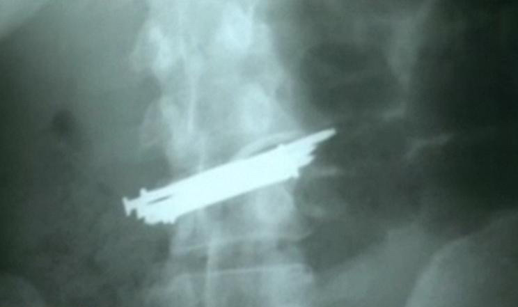 Radiografie incredibila la Lugoj. A inghitit 9 cuie si o bucata de sticla