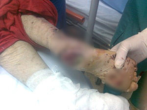 Amanunte socante, tinute ascunse de MS in cazul femeii cu rani putrezite