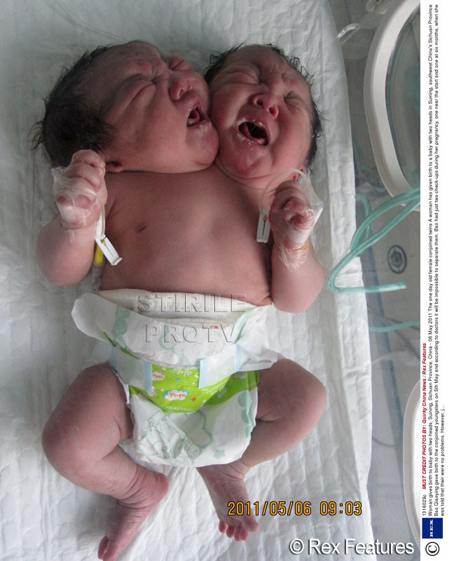 FOTO. Caz extrem de rar: gemeni topiti in China. Reactia medicilor