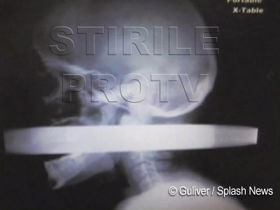 I-a intrat o teava de 5 cm in gura si i-a iesit prin craniu. FOTO