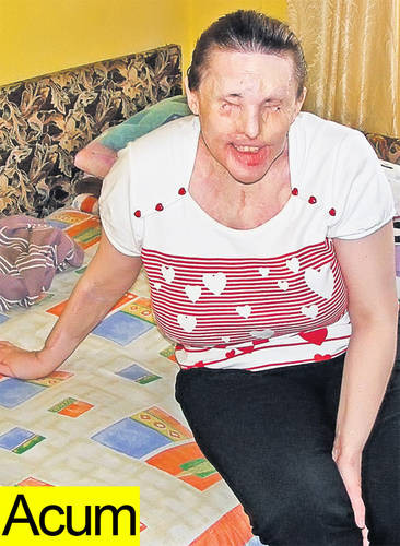 Se intampla in Romania. A fost arsa cu acid pentru greseala sotului