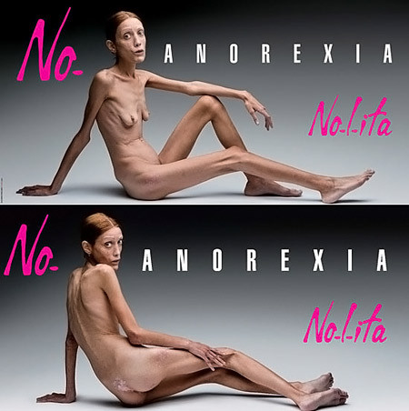 Anorexia, in cele mai socante imagini vazute vreodata. GALERIE FOTO