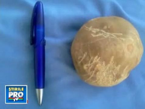 INCREDIBIL, dar adevarat. Un barbat avea in vezica un bolovan de aproape UN KILOGRAM. Vezi VIDEO