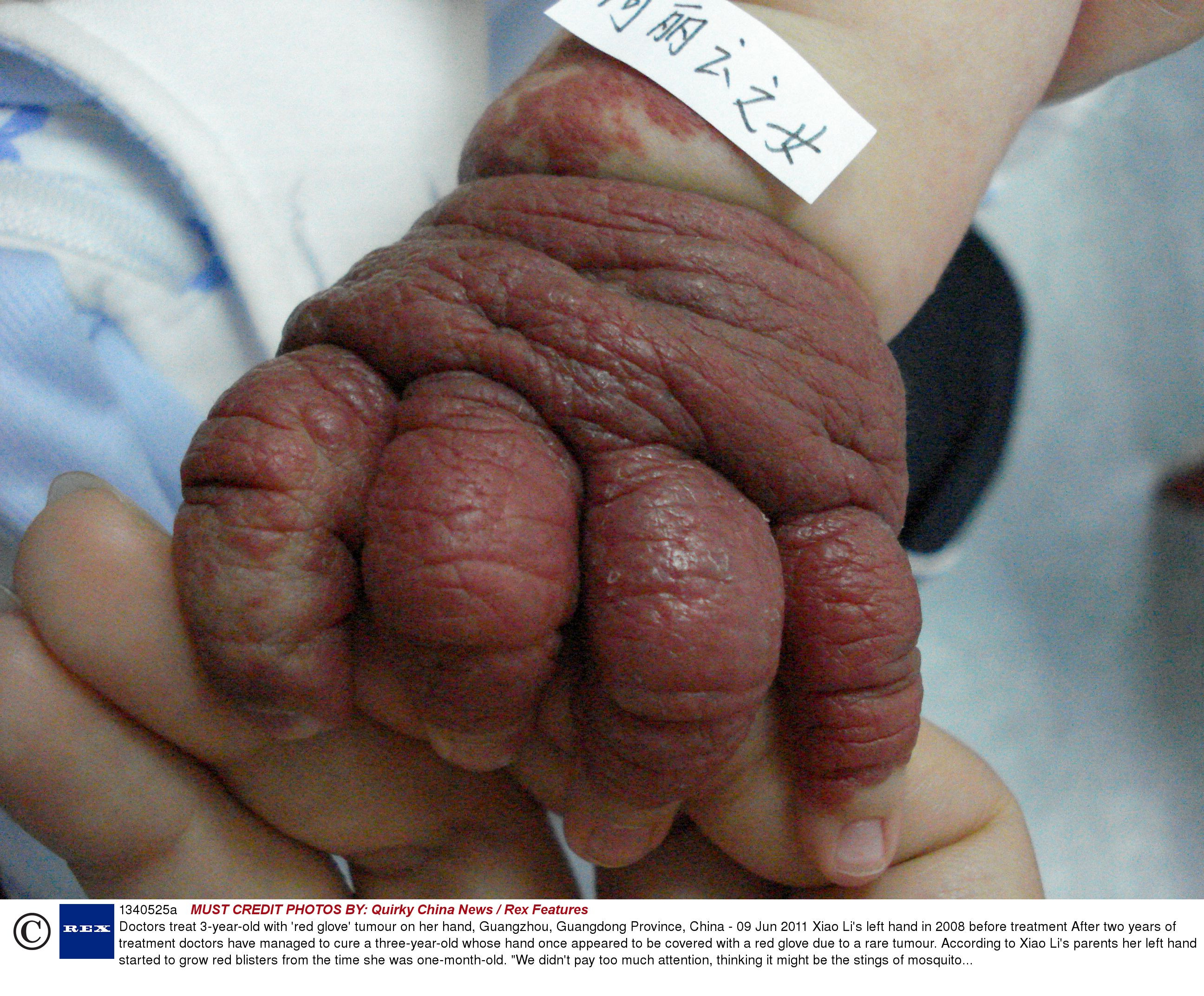 Mana mutilata de o tumoare-gigant. Cum arata dupa ce medicii au vindecat-o cu un tratament uimitor