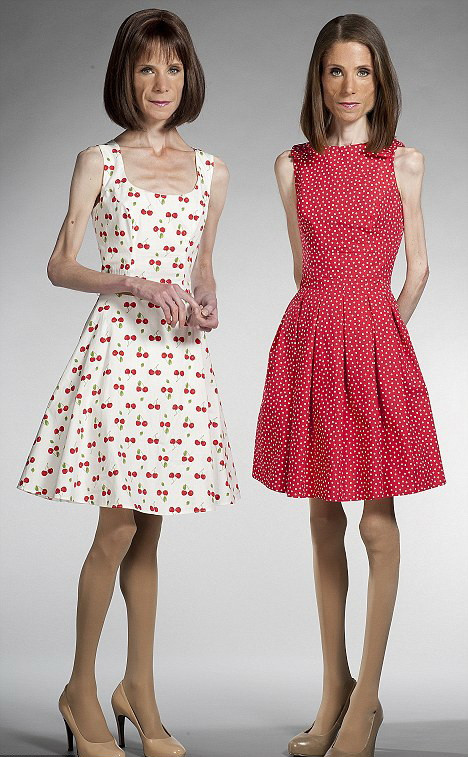 Pactul mortal cu anorexia. Cum si-au distrus viata doua gemene, de profesie doctorite. FOTO